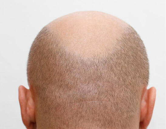 careca-antes