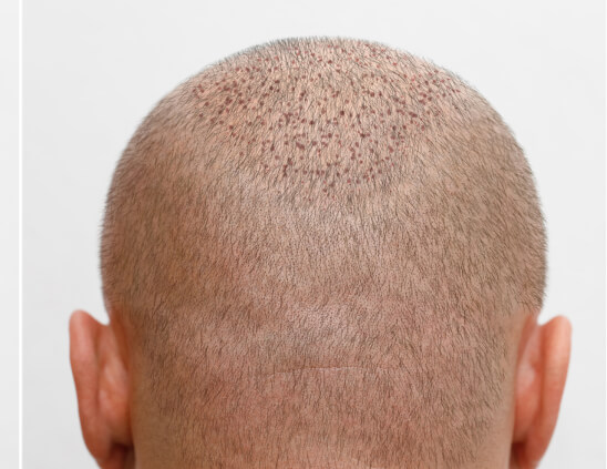 careca-depois
